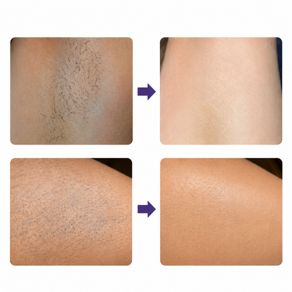 IPL Laser Hair Removal Device with Ice Cooling Technology Permanent Hair Removal for Women & Men At Home Painless Hair Removal for Face Legs Arms Underarms & Bikini
